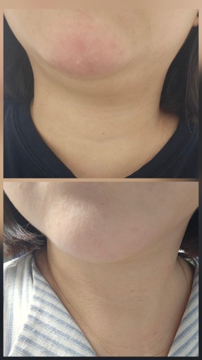 before photo: 울쎄라리프팅, 침샘보톡스, 브이올렛주사