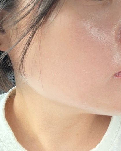 after photo: 白玉注射・点滴