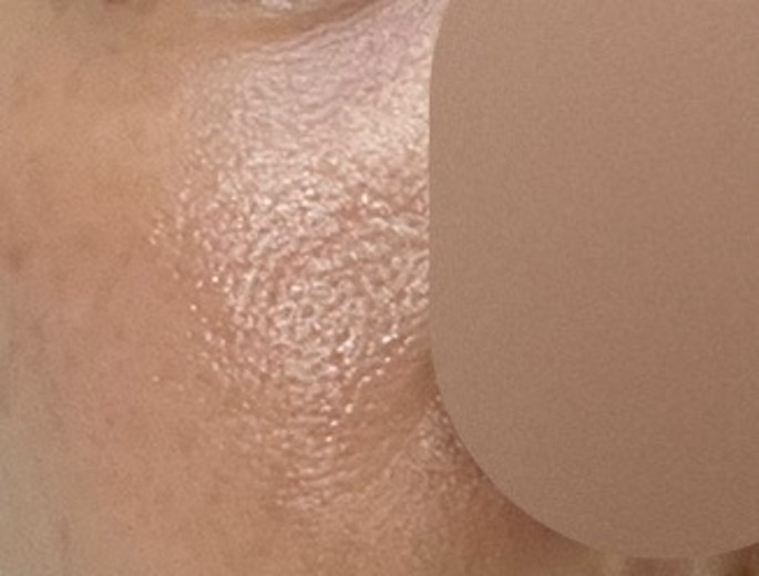 after photo: 리쥬란힐러