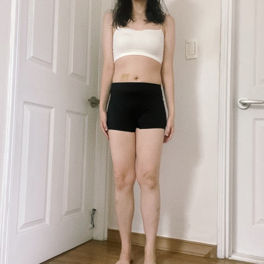 after photo: 허벅지지방분해주사