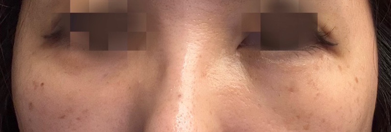 after photo: 目の下の脂肪注入(クマ治療)