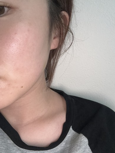 after photo: エラボトックス