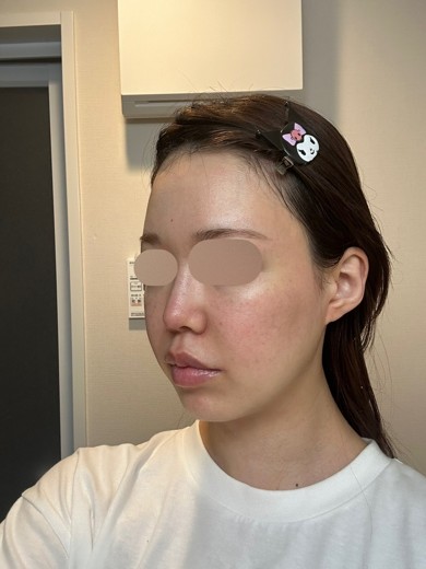 before photo: IPL(光/フォト治療)