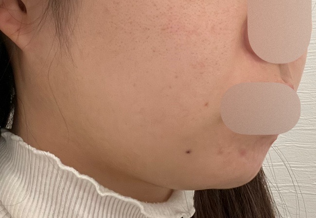 HIFU全顔650shot ウルトラフォーマーMPT【2月28日迄にご予約頂いた方