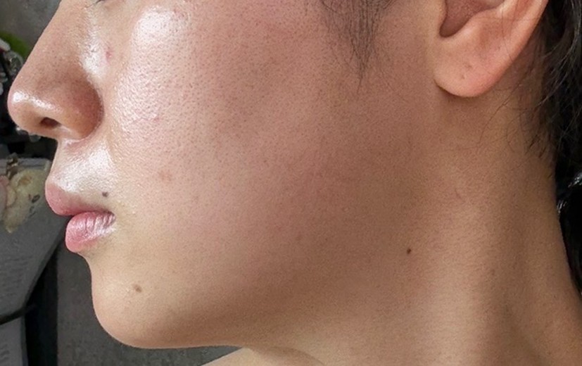 after photo: チタニウムリフト