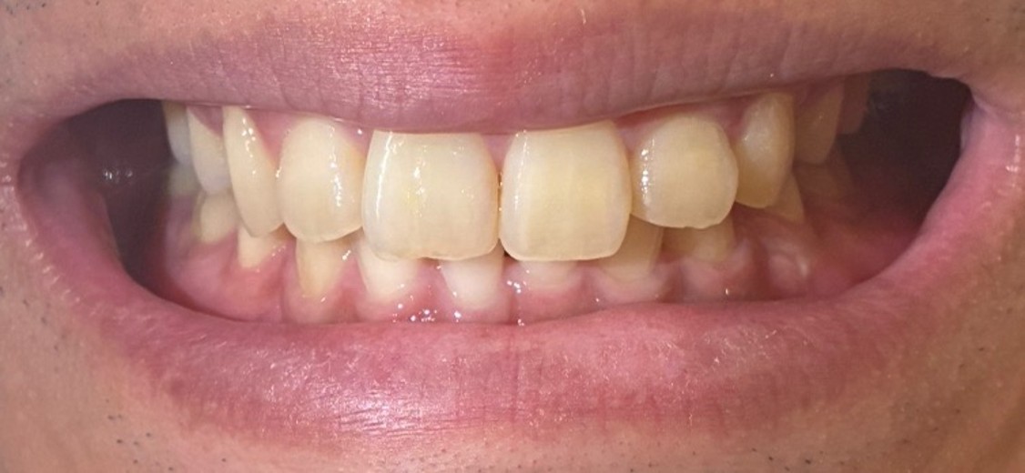 after photo: ホワイトニング