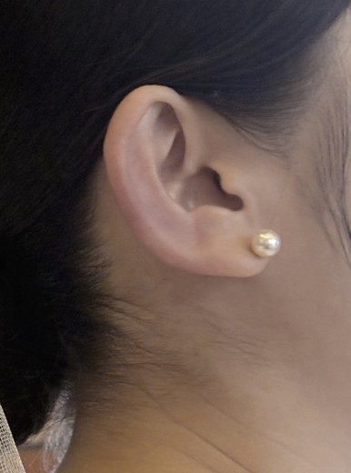 after photo: 귀필러