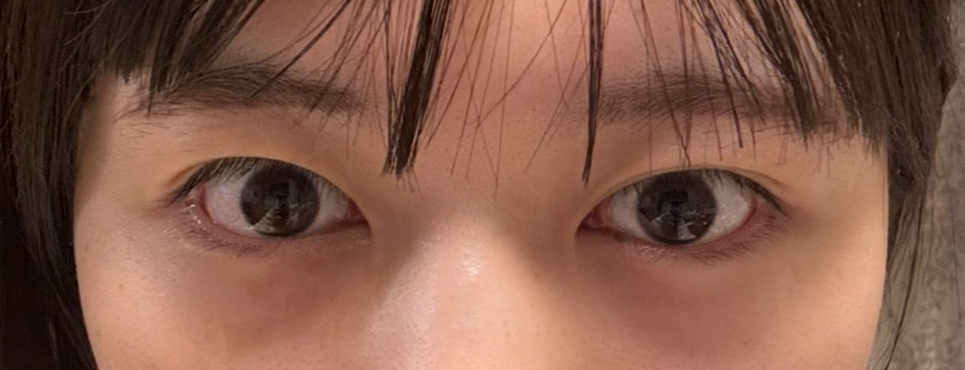 after photo: 目の下脂肪再配置(ハムラ・裏ハムラ法)