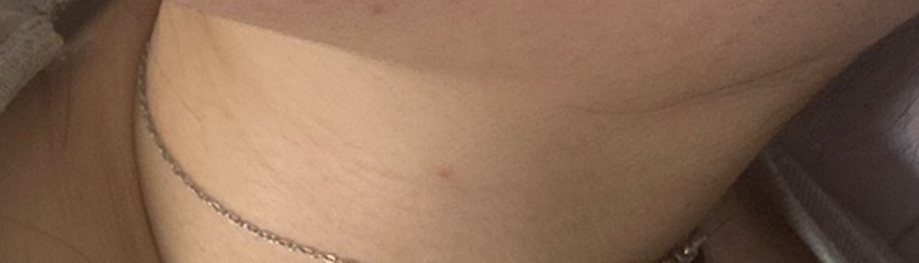 after photo: 윤곽주사, 사각턱보톡스