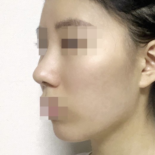 after photo: 코끝(자가연골)