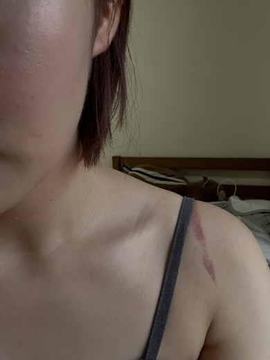 after photo: エラボトックス