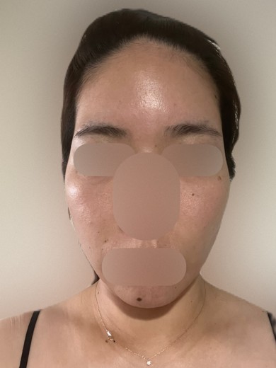 after photo: エラボトックス, 肩ボトックス(僧帽筋)