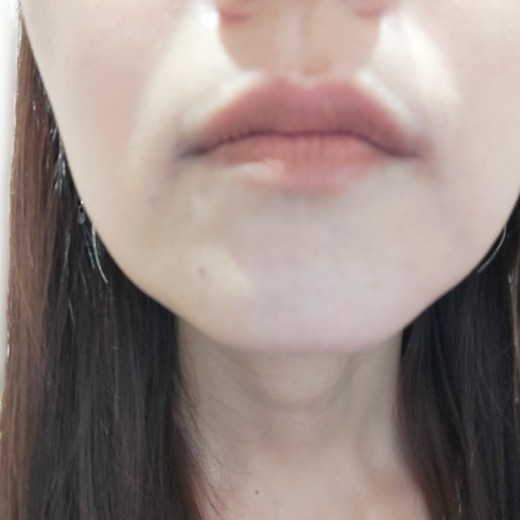 after photo: 白玉注射・点滴