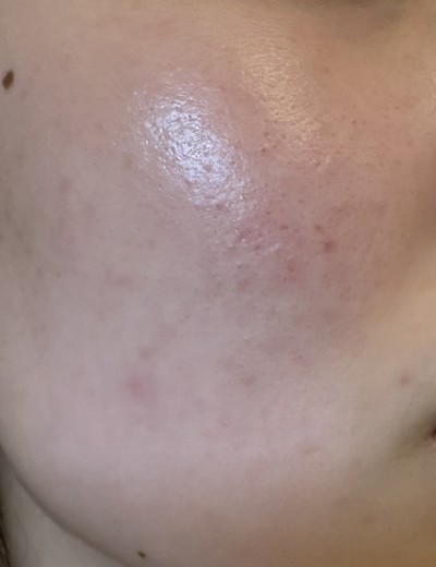 after photo: ダーマペン