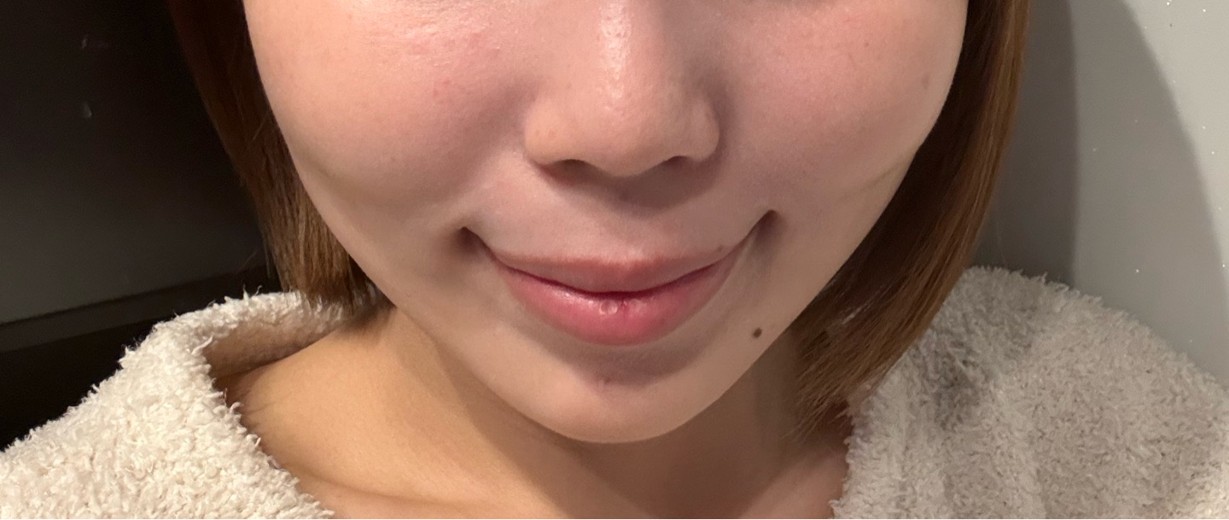 after photo: 脂肪溶解注射(顔)