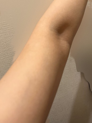 after photo: 脂肪溶解注射(腕)
