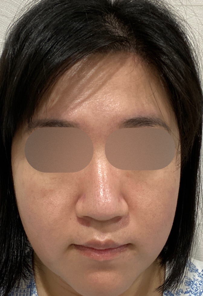 再来OK】ハイドラフェイシャル＋エレクトロポレーション | おおかみ