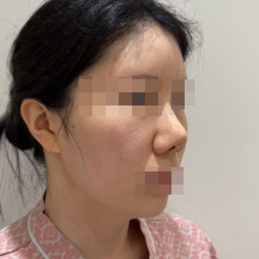 before photo: 코재수술, 콧대(보형물), 복코교정(수술)