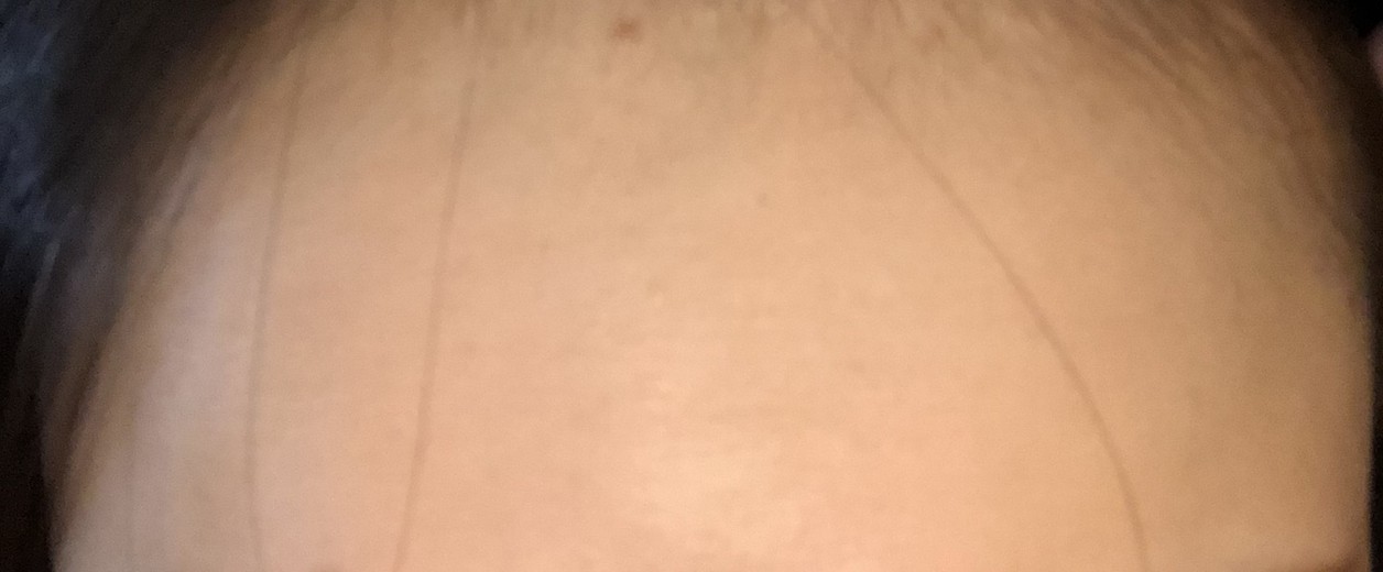after photo: ハイドラジェントル