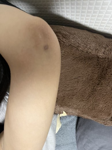 after photo: 脂肪吸引(腕)