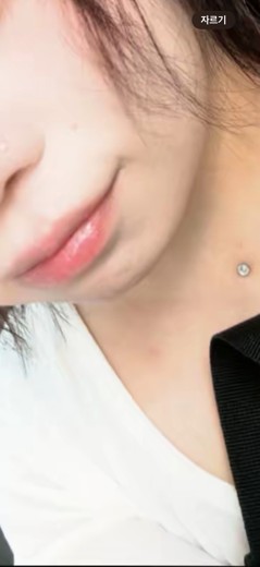 before photo: 턱끝보톡스, 턱끝필러