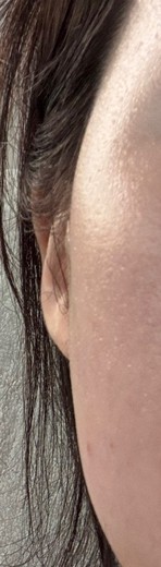 after photo: 옆볼필러