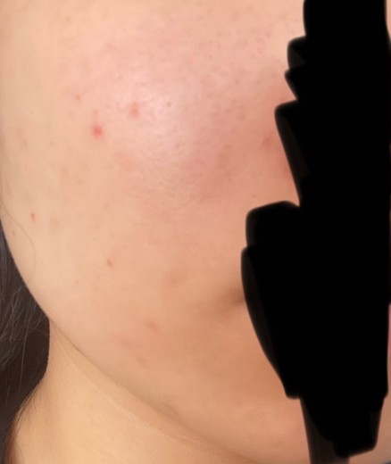 before photo: ダーマペン, ミラノリピール