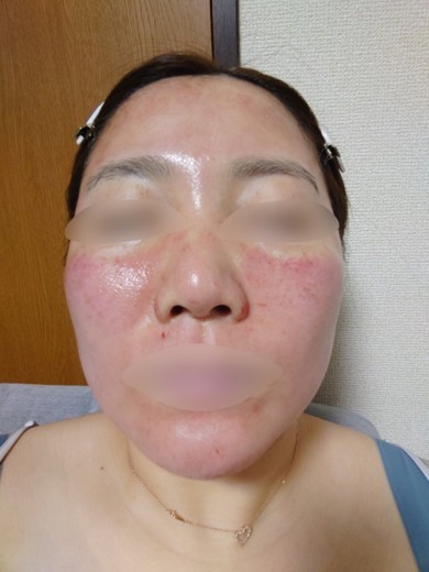 before photo: ダーマペン