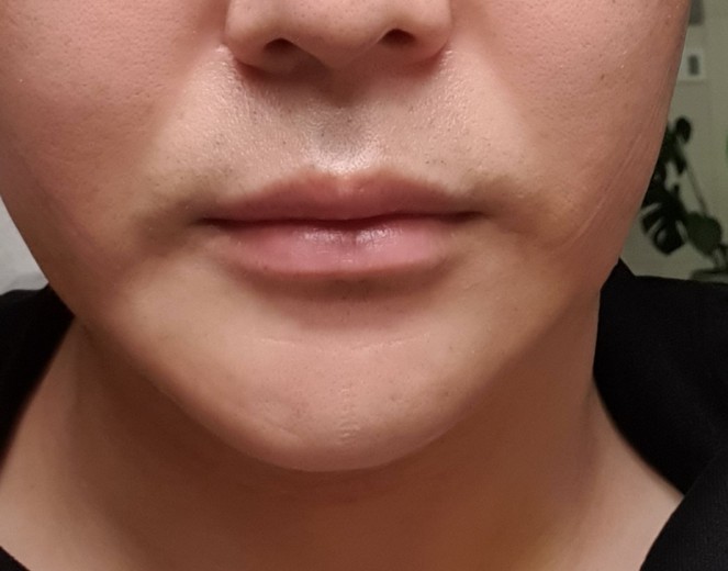 after photo: 이중턱지방흡입, 이중턱근육묶기