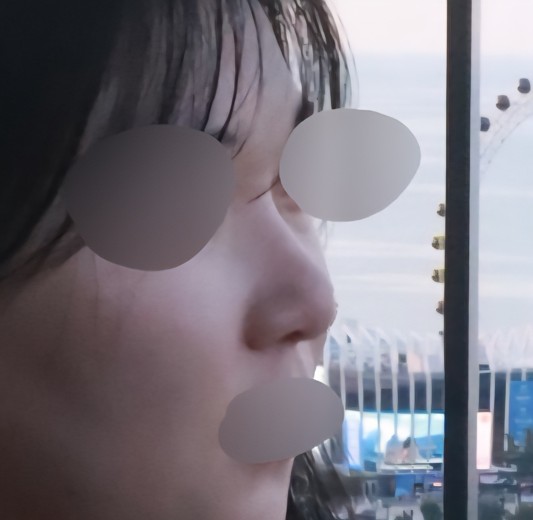 before photo: 비중격만곡증수술, 콧대(자가조직), 코끝(자가연골)