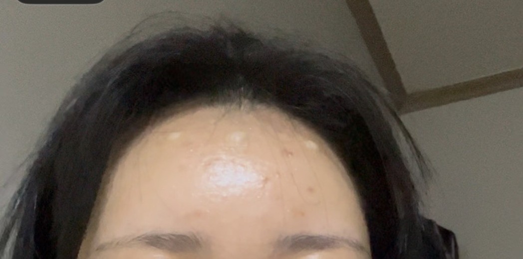 after photo: 이마필러