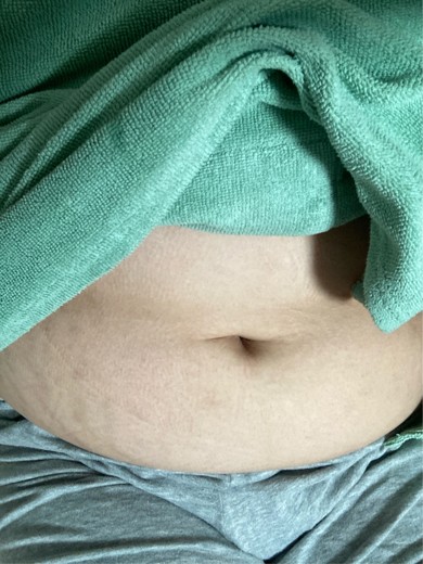 before photo: 脂肪溶解注射(腹部)