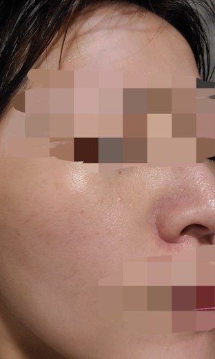 after photo: ハイドラフェイシャル, 診断・検査