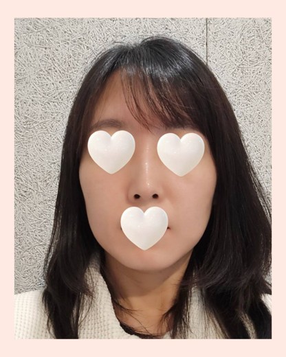 before photo: 티타늄리프팅