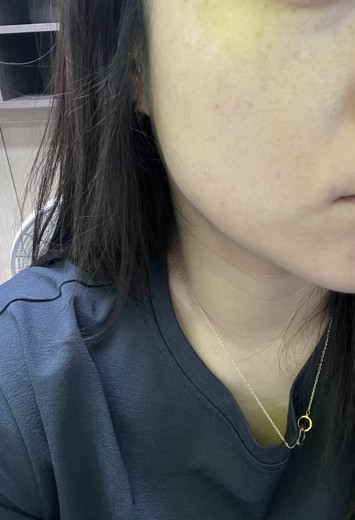 after photo: 사각턱보톡스