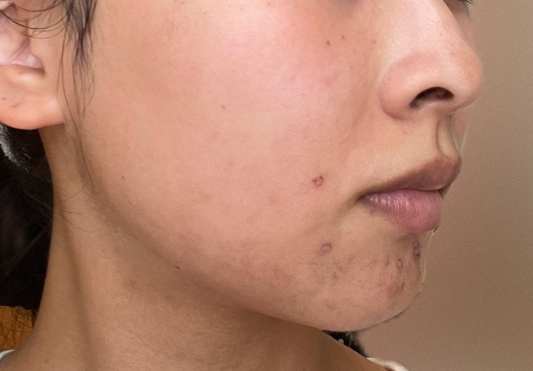after photo: IPL(光/フォト治療), ルメッカ