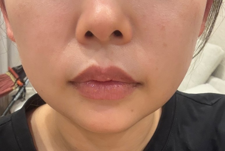 after photo: あごヒアルロン酸, 頬ヒアルロン酸