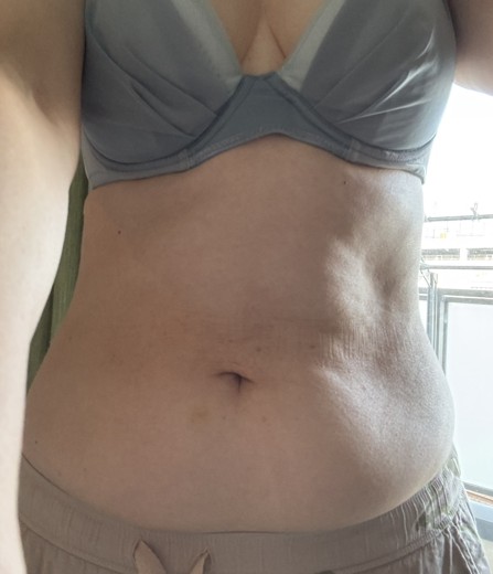after photo: 脂肪冷却(腹部)