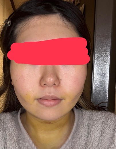 after photo: 糸リフト, 脂肪吸引(顎下), 脂肪吸引(顔), 脂肪吸引(頬)