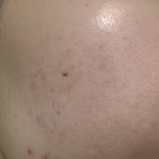 after photo: 아쿠아필링