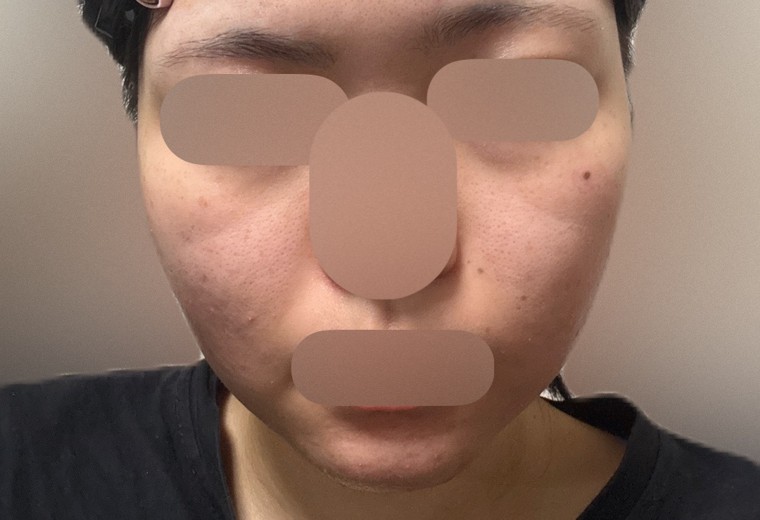 after photo: IPL(光/フォト治療)