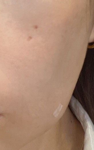 after photo: 前頬骨ヒアルロン酸