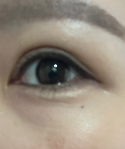 after photo: 涙袋ヒアルロン酸