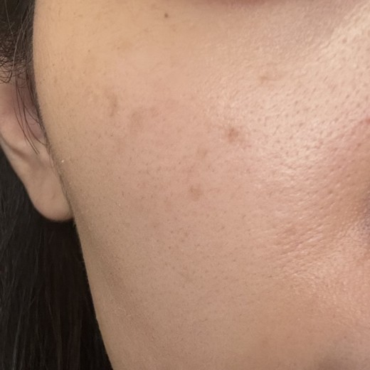 after photo: IPL(光/フォト治療), 診断・検査