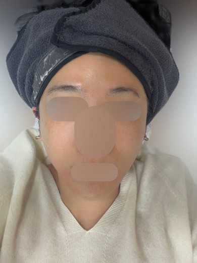 after photo: 튠라이너