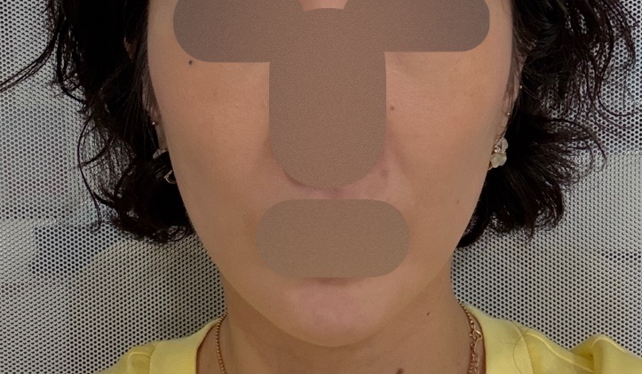 5D Collagen Lift
