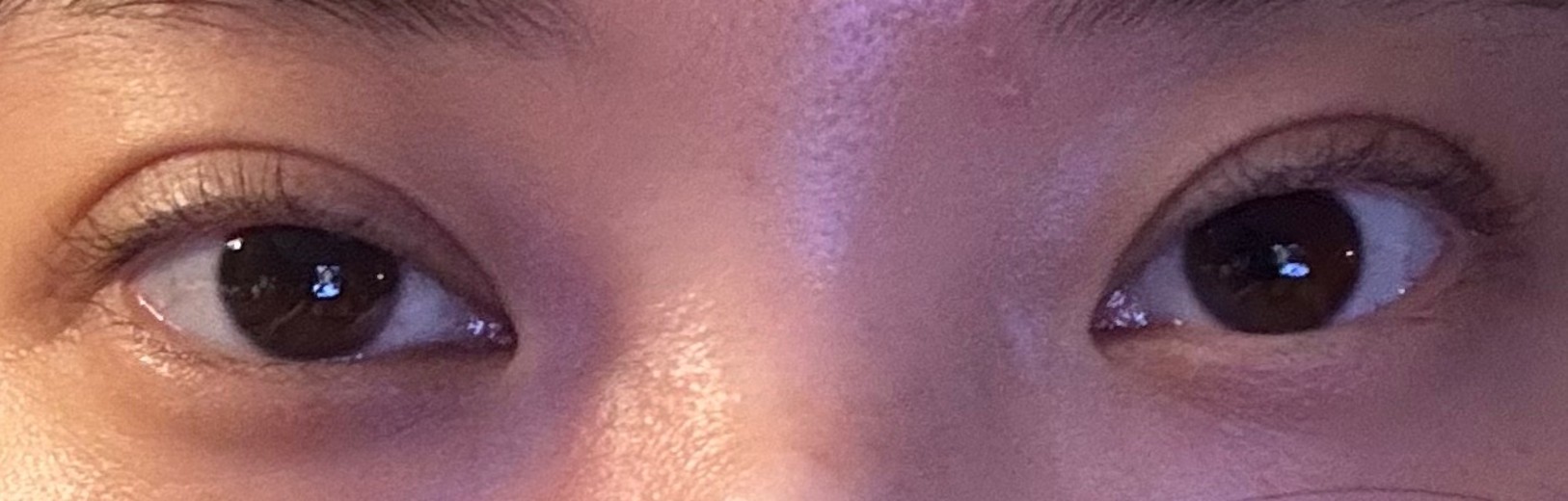 before photo: 눈재수술, 눈매교정