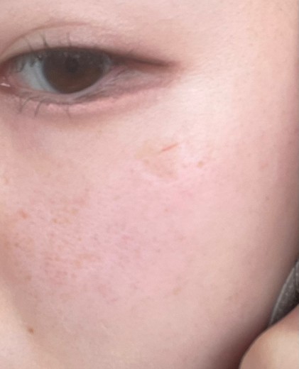 before photo: IPL(光/フォト治療), ピーリング, ルメッカ