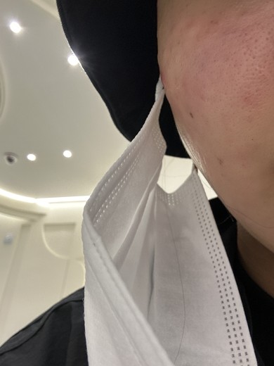 after photo: 리쥬란힐러, 쥬베룩