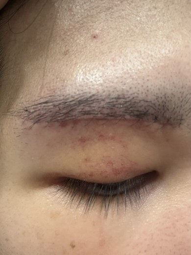 after photo: 眼瞼下垂(目つき矯正)